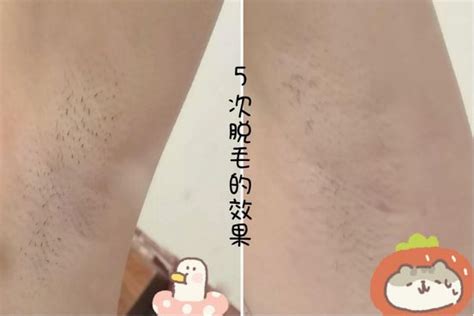 脫毛膏脫腋毛會(huì)不會(huì)引起狐臭(狐臭怎么解決根除)縮略圖