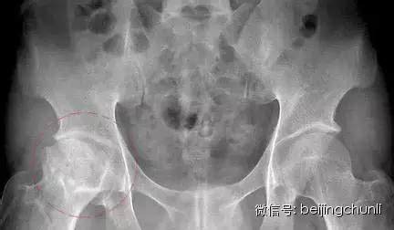 黃瓜籽對(duì)股骨頭壞死功效與作用,股骨頭壞死吃黃瓜籽管用嗎縮略圖