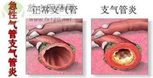 氣管炎的癥狀(氣管炎的癥狀和表現)縮略圖