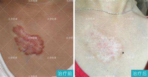 夾板燙傷的疤痕怎么消,卷發棒燙傷的疤痕多久能消退縮略圖