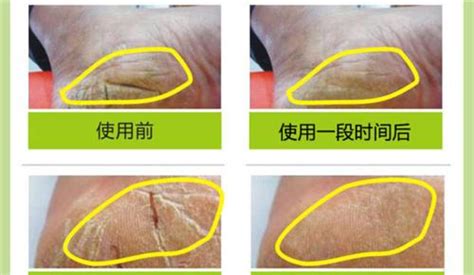皮鞭抽打皮膚開(kāi)裂(皮鞭抽打痕跡怎樣消除)縮略圖