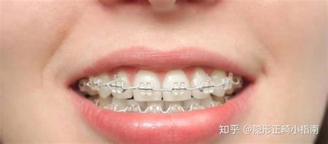 隱形牙套和鋼絲牙套哪個(gè)效果更好,鋼絲牙套和隱形牙套效果哪個(gè)好縮略圖