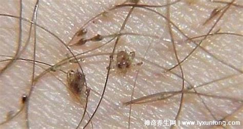 床單上有陰虱怎么弄,怎么判斷自己長(zhǎng)了陰虱縮略圖
