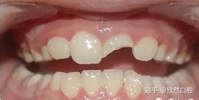 大門牙磕掉了一半怎么辦,補(bǔ)牙多少錢(大門牙磕掉了一半怎么辦,補(bǔ)牙多少錢蘇州)縮略圖