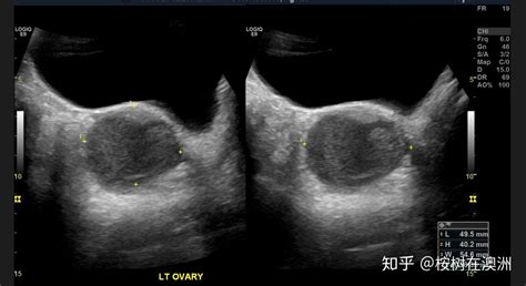 巧克力囊腫是怎么回事,巧克力囊腫是怎么回事 需要治療嗎縮略圖